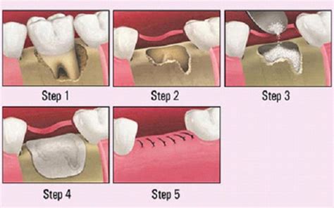 Bone Grafting Kingston Oral Surgery