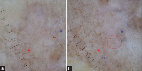 Dermoscopy A Reliable Guide In The Diagnosis Of Lichen Planus Like