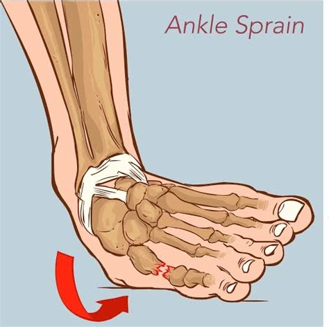 Anatomy Of Ankle Sprain