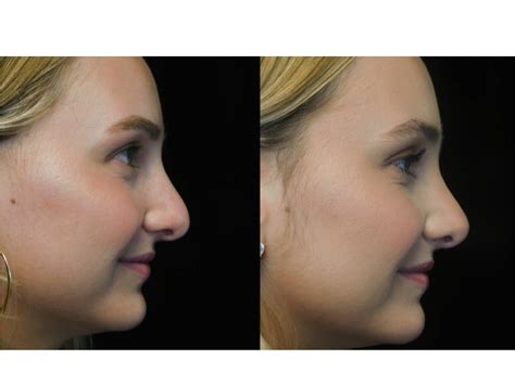 What Is Closed Rhinoplasty Closed Rhinoplasty For Bulbous Nose Tip