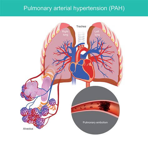 Pulmonary Artery Hypertension