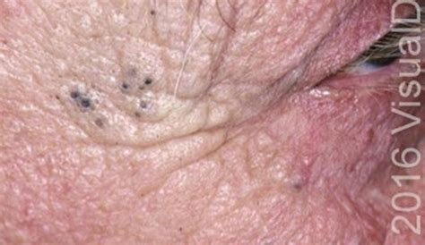 A 72 Year Old Man With Black Skin Lesions Page 2 Of 2 Journal Of