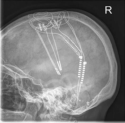 Lateral Cranial X Ray Showing Four Dbs Electrodes With Two Connectors