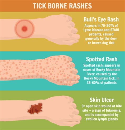 Tick Borne Rashes Tick Bite Tick Repellent Ticks