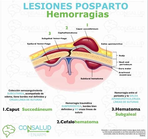 Bossa Serossanguínea E Cefalohematoma