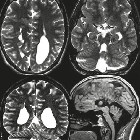 B Female 32 Years L Sided Temporal Lobe Epilepsy Mri Shows A