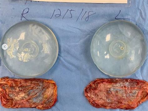 What do breast implants look like. What breast implants look like after they've been removed