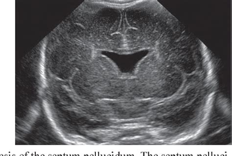 Figure 1 From Neonatal Head Ultrasound Systematic Approach To