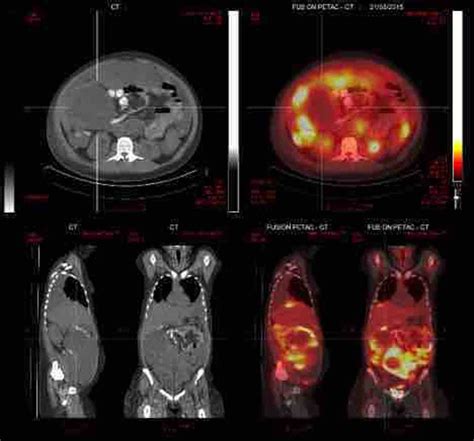 Cureus Whole Abdominal Pelvic Radiotherapy In The Management Of