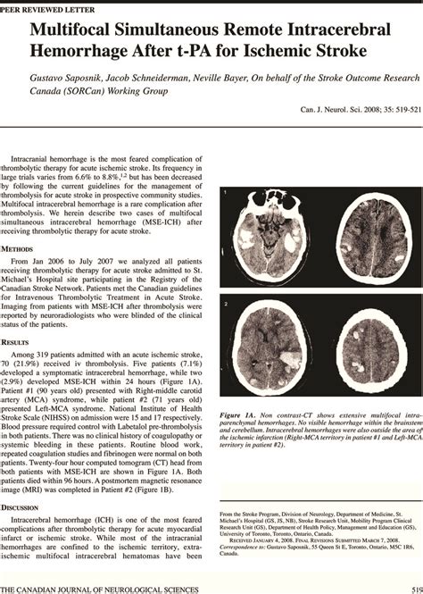 Multifocal Simultaneous Remote Intracerebral Hemorrhage After T Pa For Ischemic Stroke
