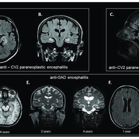 Representative Mri Findings Of Our Study Cohort Ab Brain Mri From A