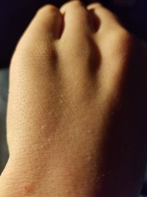 I Have These Weird Bumps On My Hand I Dont Feel Any Pain Or Things