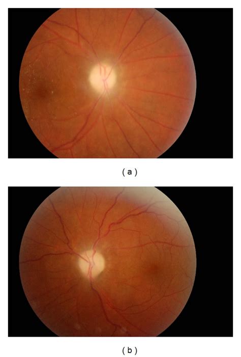 Bilateral Ischemic Optic Neuropathy The Marked Edema In The Optic Disc