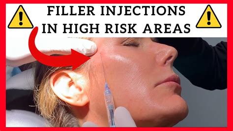 Filler Injections In High Risk Areas Temples Forehead Tear Trough Preauricular And Jawline