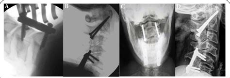 A C5 C6 Facet Dislocation Was Treated With Lateral Masses Plating B