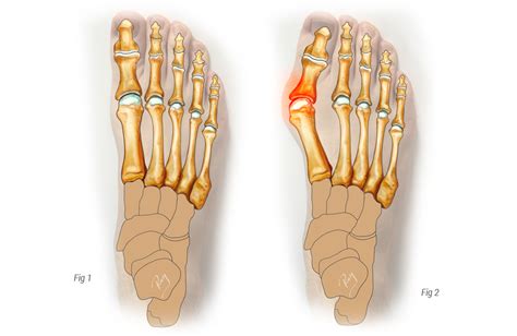 Bunionectomy And First Metatarsal Osteotomy Animation Ph