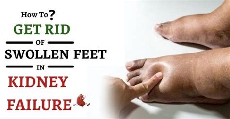 How To Get Rid Of Swollen Feet In Kidney Failure