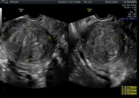 Fibroids Diagnostic Ultrasound