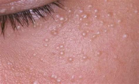Milia Clogged Pores Bumps Acne Symptoms