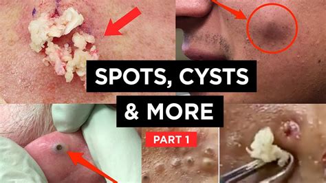 Spot Popping Cysts Pimples And More 2023 Compilation Tiktok Youtube