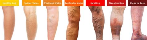 Types Of Varicose Veins Pictures Symptoms And Pictures