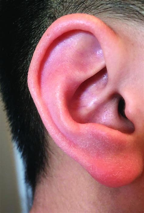 Rubella Rash Behind Ears