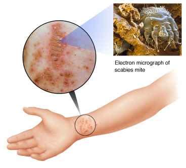 Scabies Causes Symptoms Treatment And Prevention