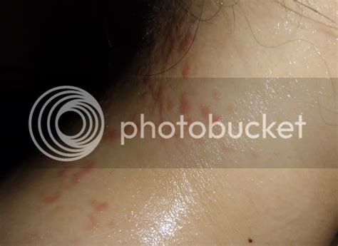 Red Itchy Rashes On Neck Ask Metafilter