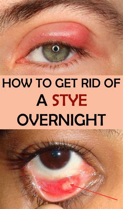 What To Do For A Stye On Upper Eyelid