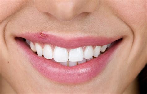 What Are Cold Sores Causes Symptoms And More Abreva