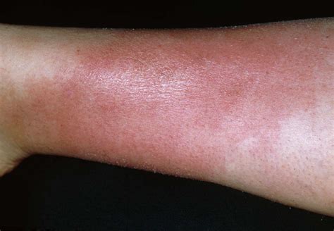 How Cellulitis Can Be Treated