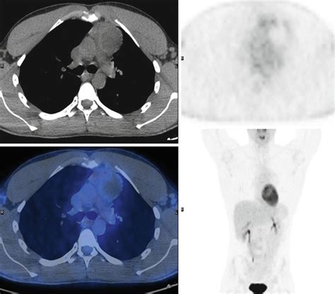 Petct In Hodgkins Lymphoma Teaching Cases Radiology Key