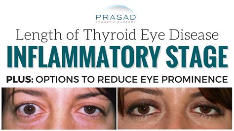 How Long Thyroid Eye Disease Graves Disease Lasts And Reducing Eye Prominence Youtube