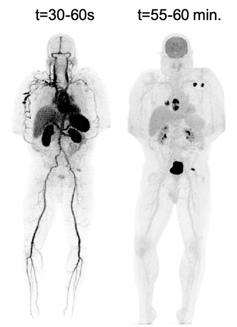 201912 First Total Body Dynamic Pet Scan Of A Cancer Patient