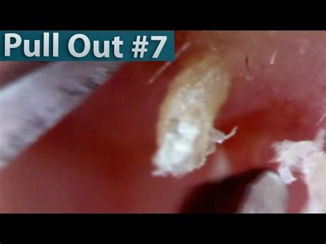 Read on to find treatments and tips for good skin care. #07 Pull Out Blackheads Close up - Blackheads Removal ...