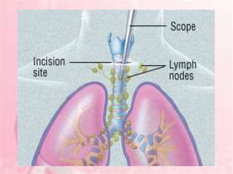 How Lung Cancer Spreads To Lymph Nodes