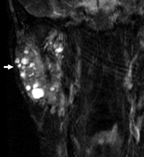 Marginal Zone B Cell Non Hodgkins Lymphoma Of Mucosa Associated