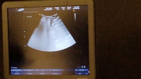 Kidney Ultrasound Youtube