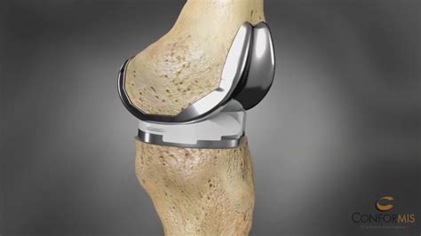 3d Printing Offers New Tech For Replacement Knees Katu