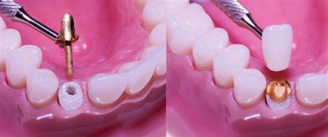 Dental Post And Core Procedure Post And Core Technique Dental Posts