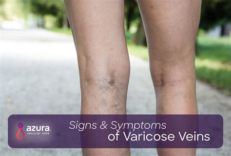 Signs And Symptoms Of Varicose Veins Azura Vascular Care