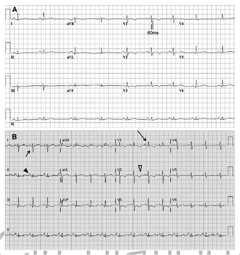 Ecgs In Patients With Right Sided Heart Disease A Ecg From A Patient