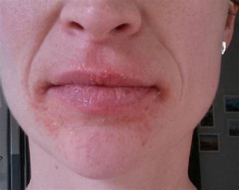 Skin Rash Around Lips