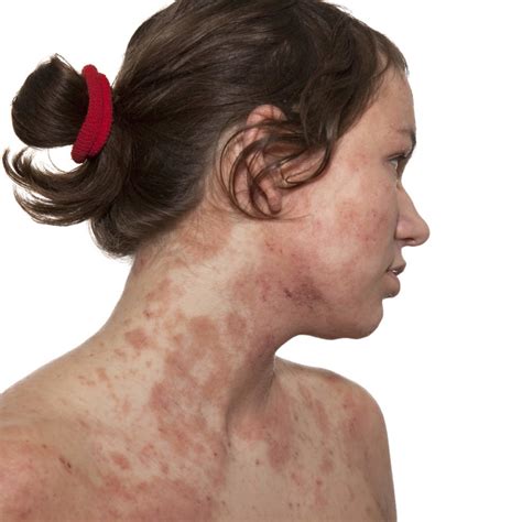 Quelle Différence Entre Dermite Séborrhéique Et Dermatite Atopique