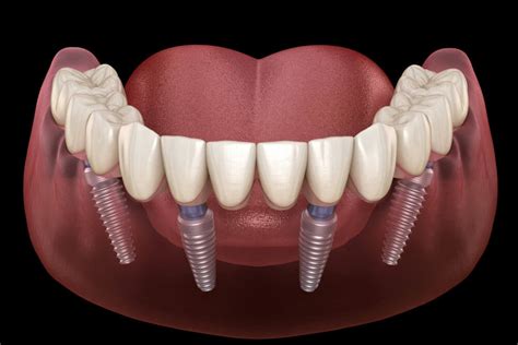 All On 4 Implant Supported Denture Implant • Beachton Denture Clinic