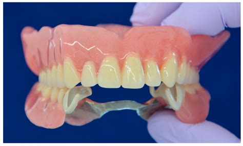 Dentistry Journal | Free Full-Text | Use of a Polyetheretherketone ...