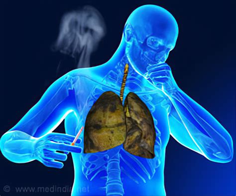 Causes And Prevention Of Tuberculosis Health Gadgetsng