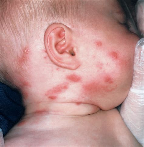 Herpes Zoster In The First Year Of Life Following Postnatal Exposure To