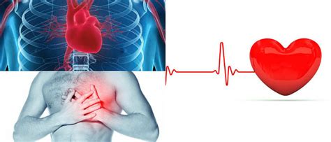 Miocardiopatia Dilatada Causas Síntomas Diagnóstico y Tratamiento