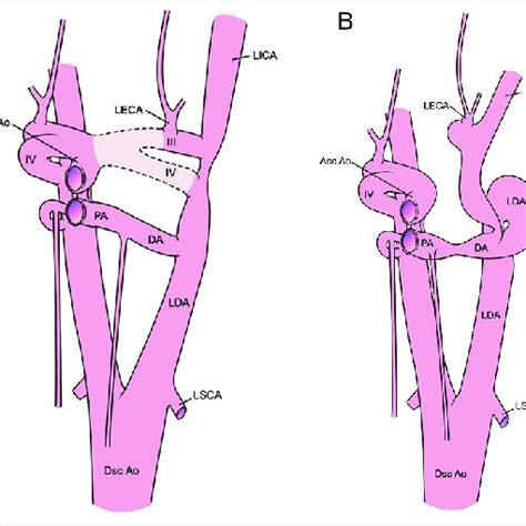 A A Depiction Of Normal Aortic Arch Anatomy In The Carnegie Stage 16